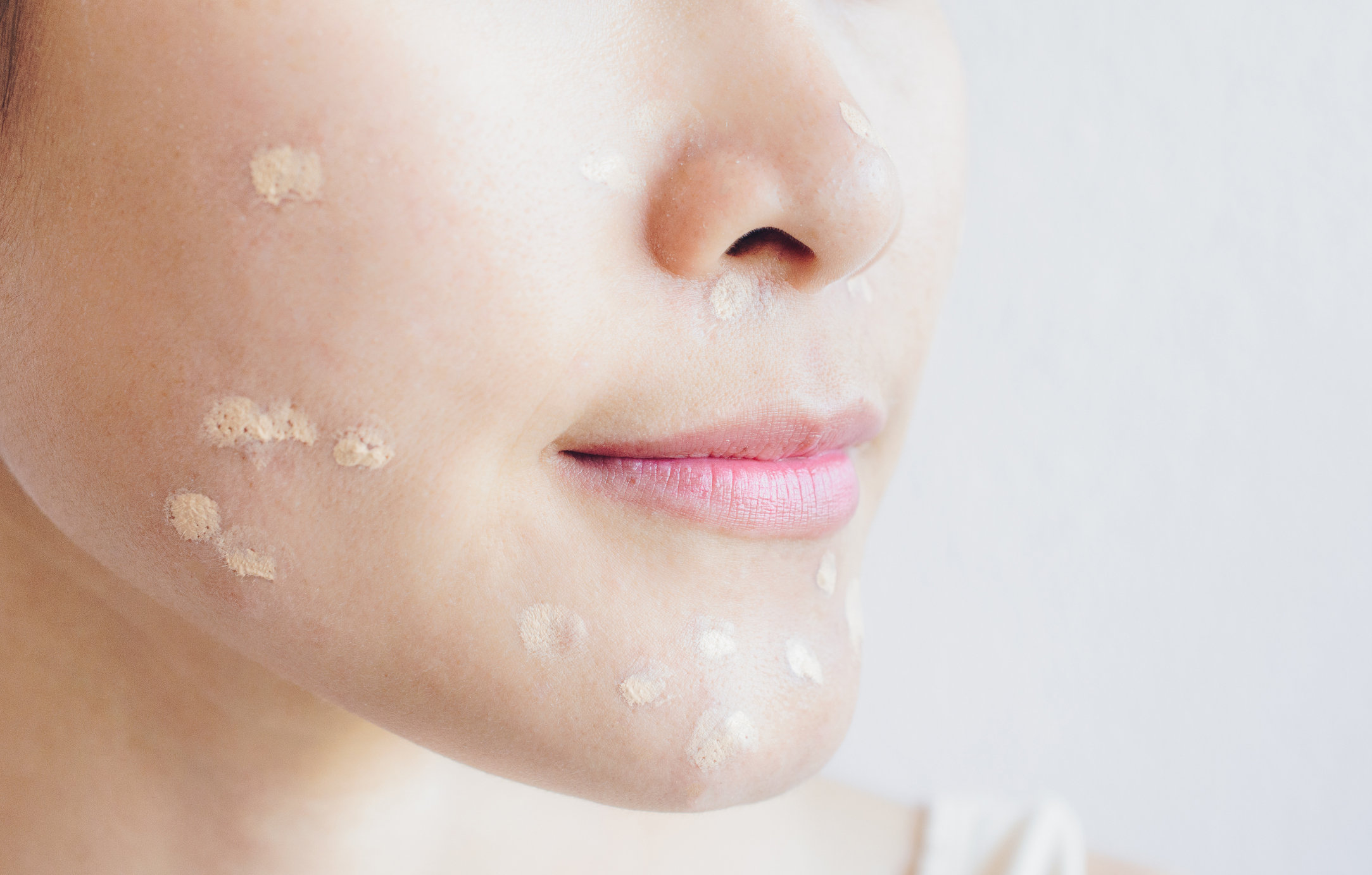 Что такое акне (угри)? Симптомы, причины и лечение акне