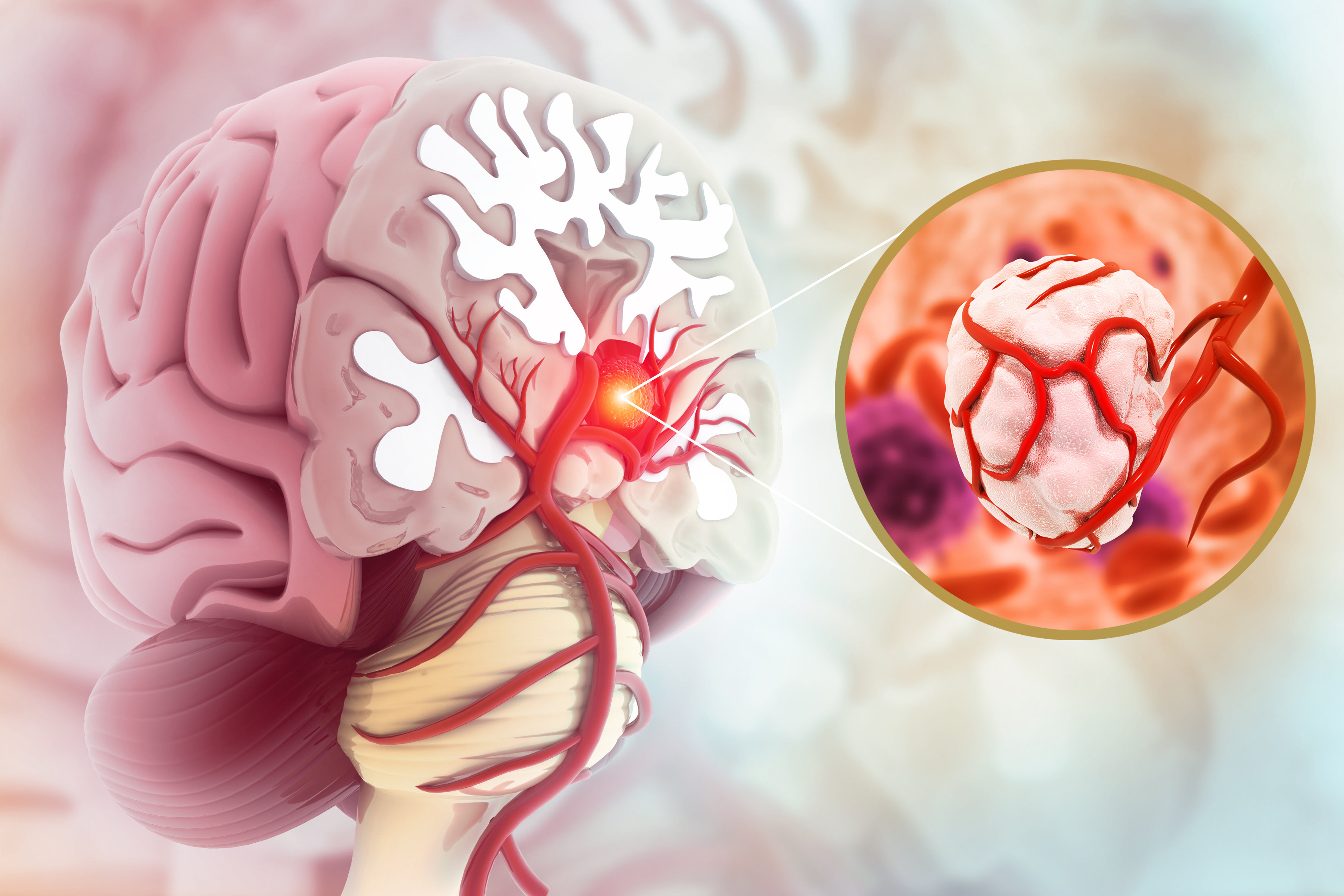 Симптомы и методы лечения опухоли мозга