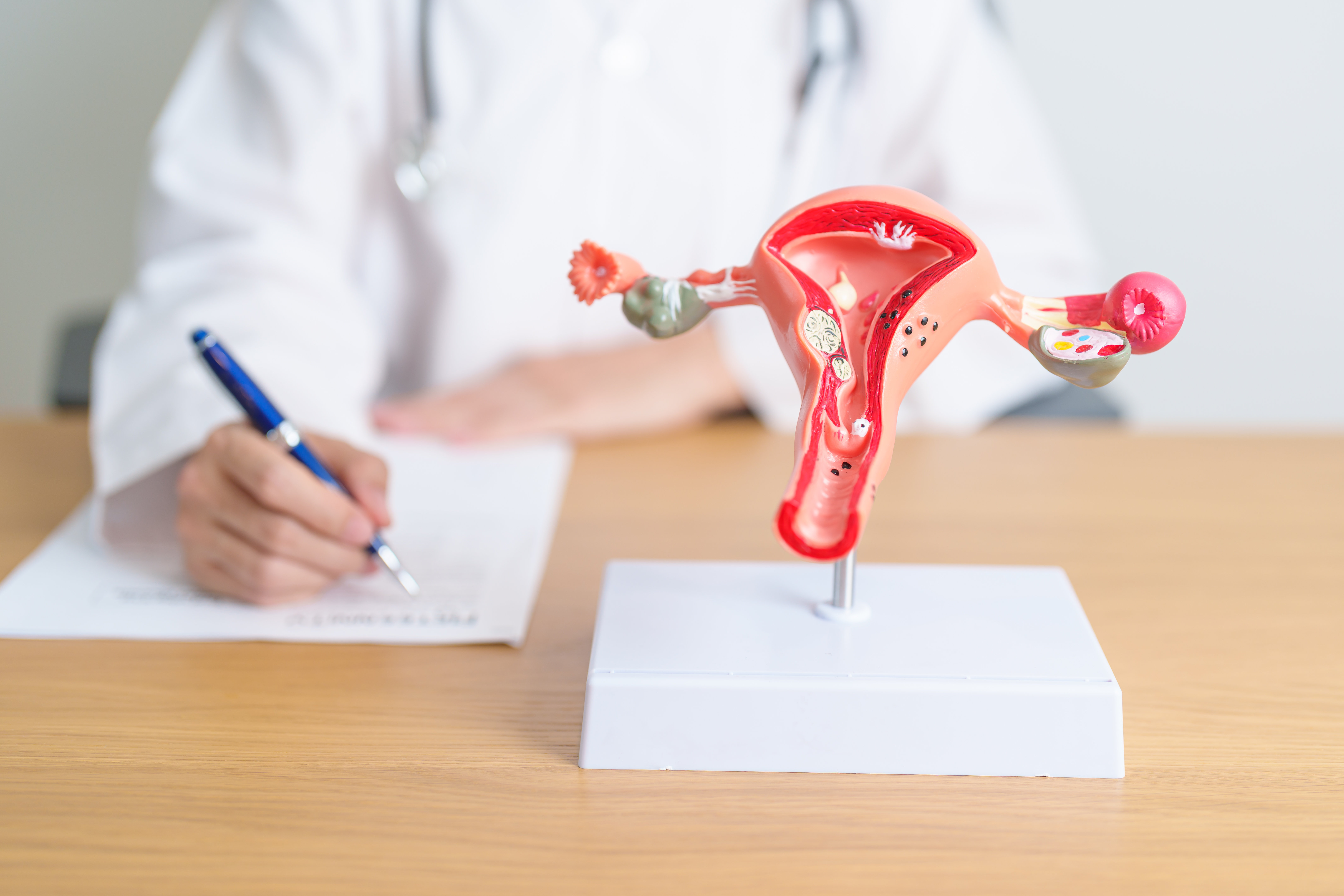 Что такое шоколадная киста (эндометриоз), её симптомы и лечение