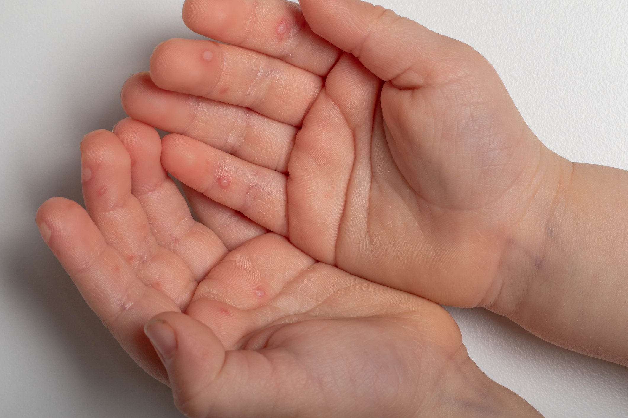 Что такое болезнь рук, ног и рта? Симптомы, диагностика и лечение