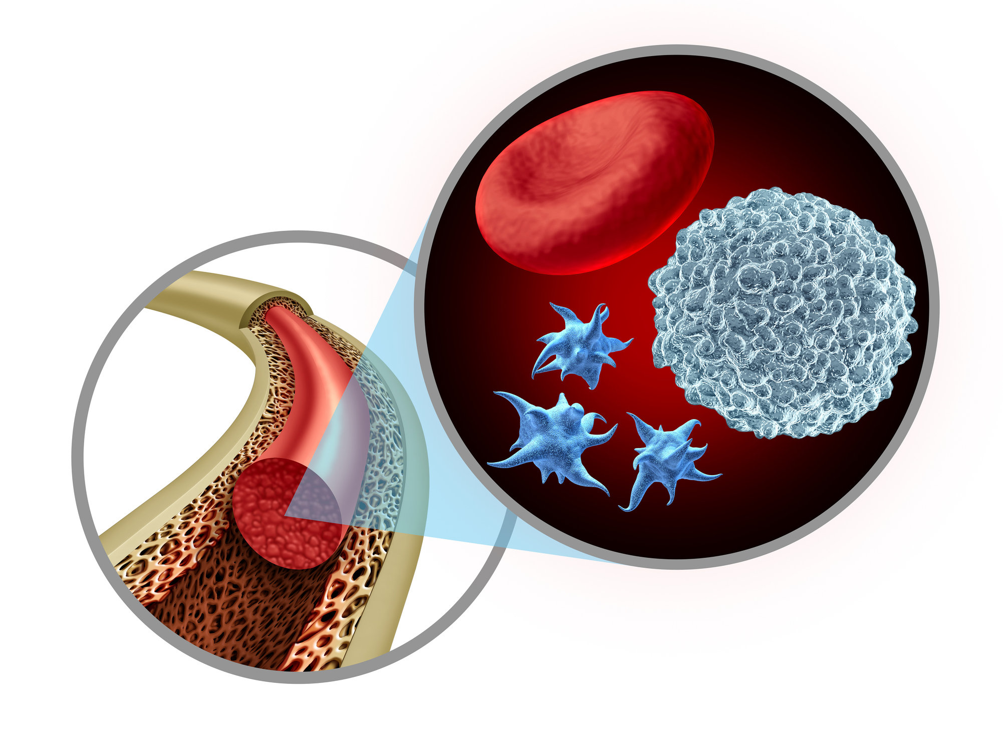 Что такое рак костного мозга, его симптомы, диагностика и лечение