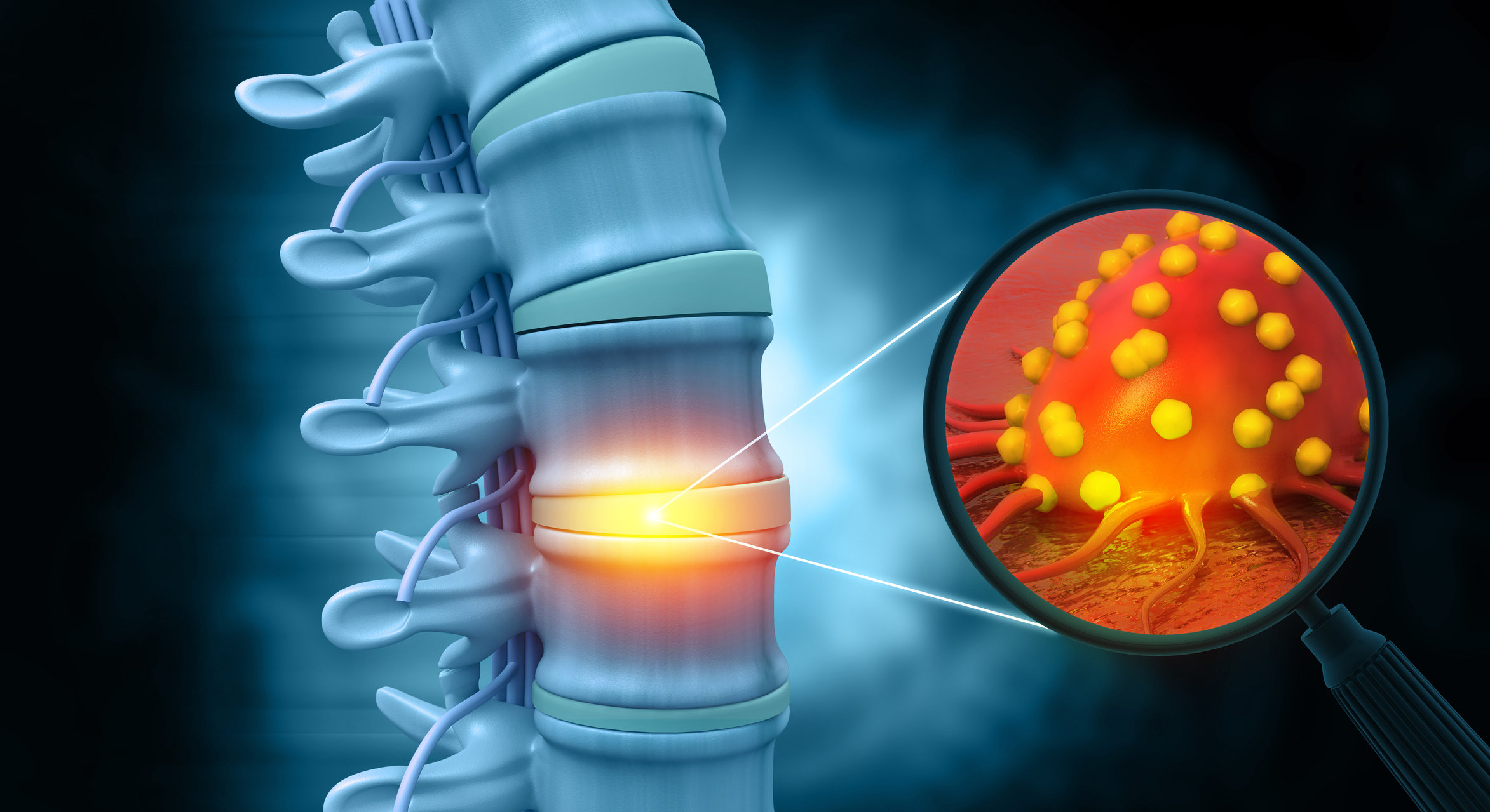 Костные опухоли