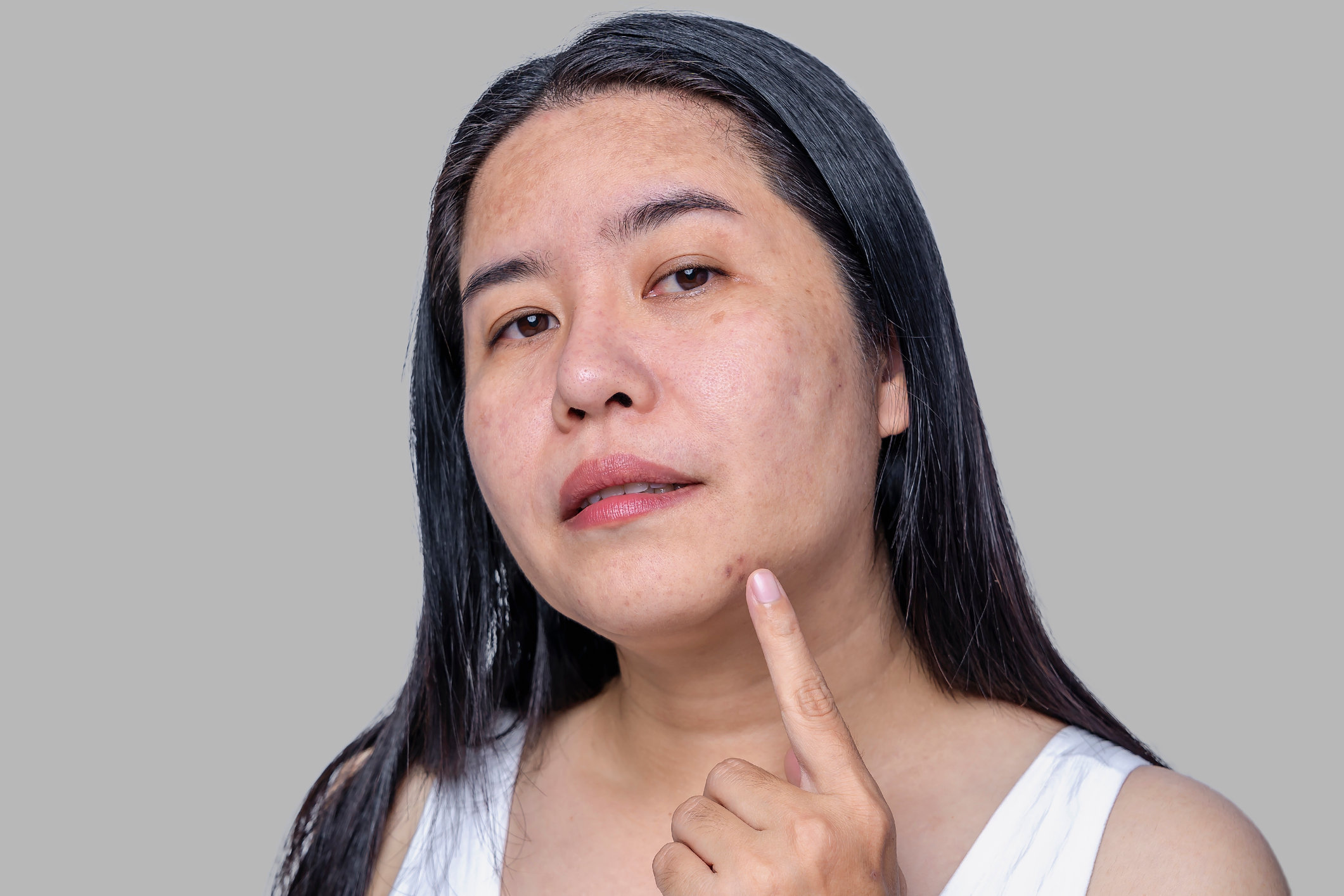 Лечение пигментации