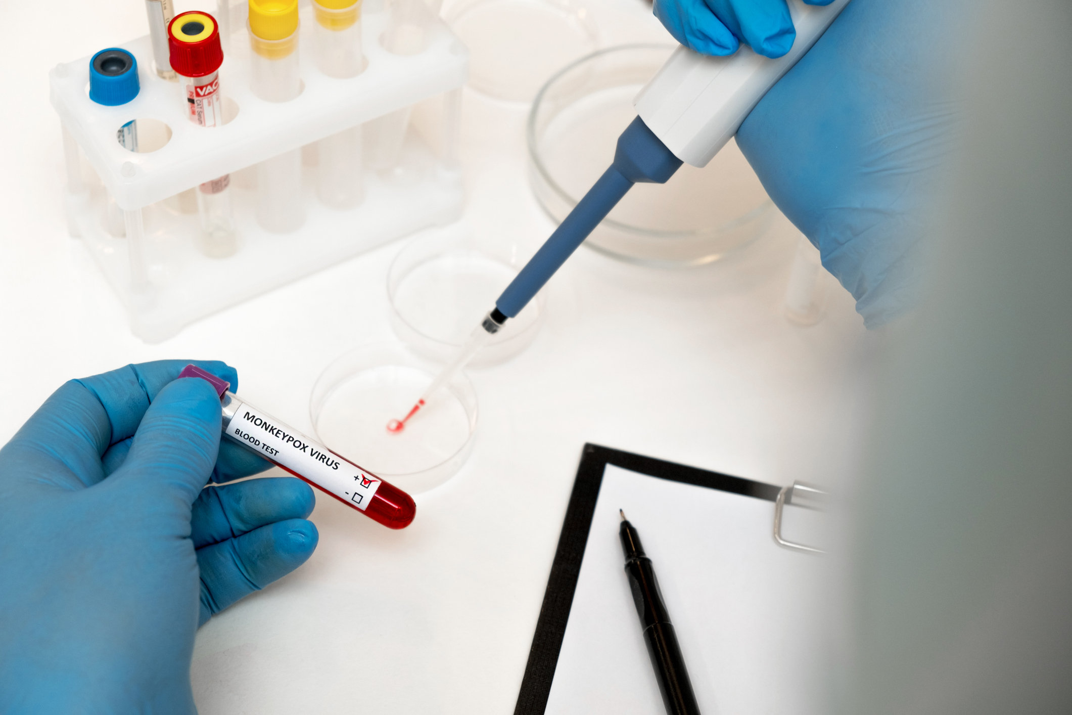 Все о вирусе обезьяньей оспы