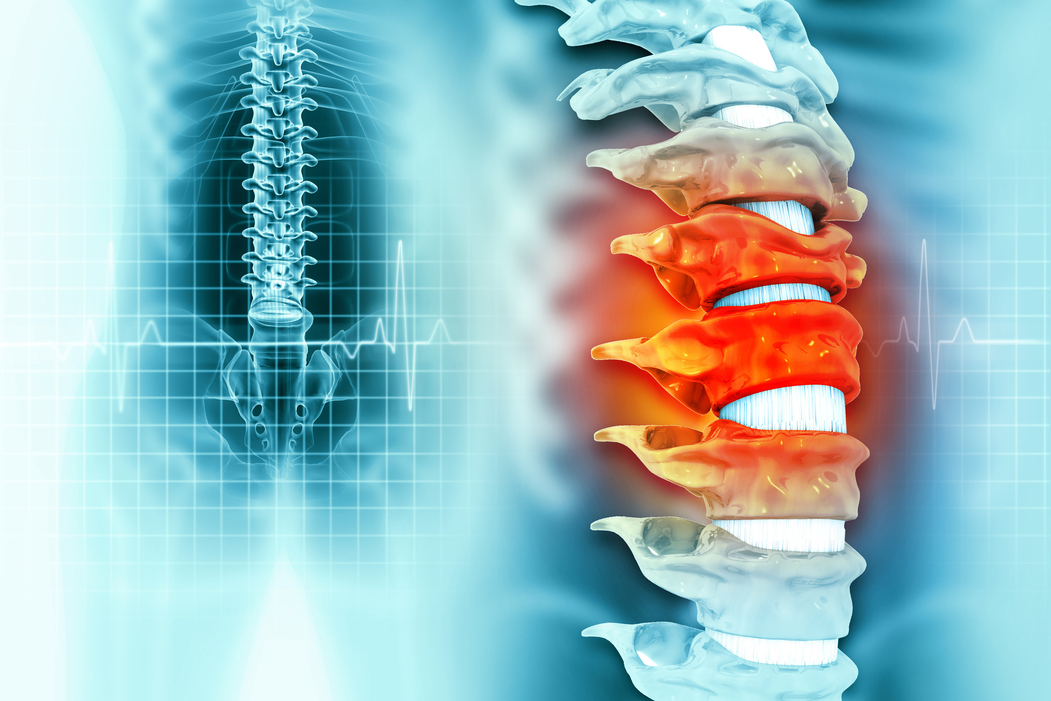 Что такое параплегия? Какое у нее лечение?