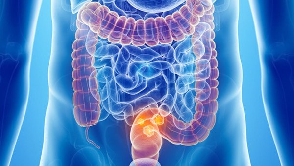 Исследования рака прямой кишки переопределят диагностику и лечение