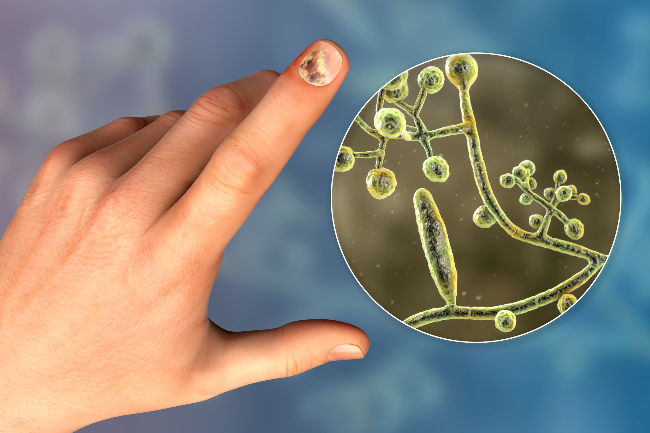 Грибок ногтей: что это, симптомы, диагностика и лечение