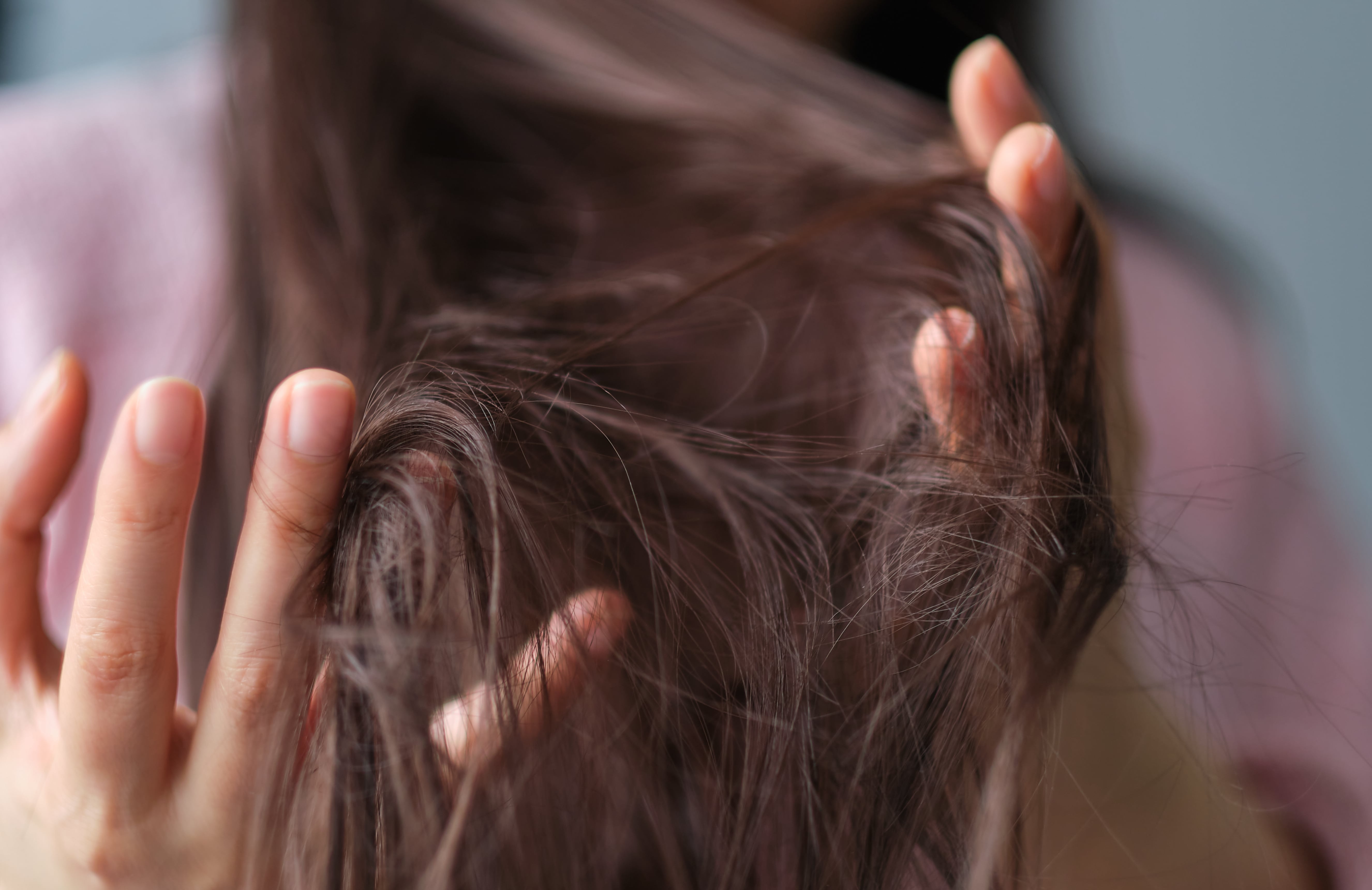 Триходилломания (болезнь выдергивания волос) — что это такое?