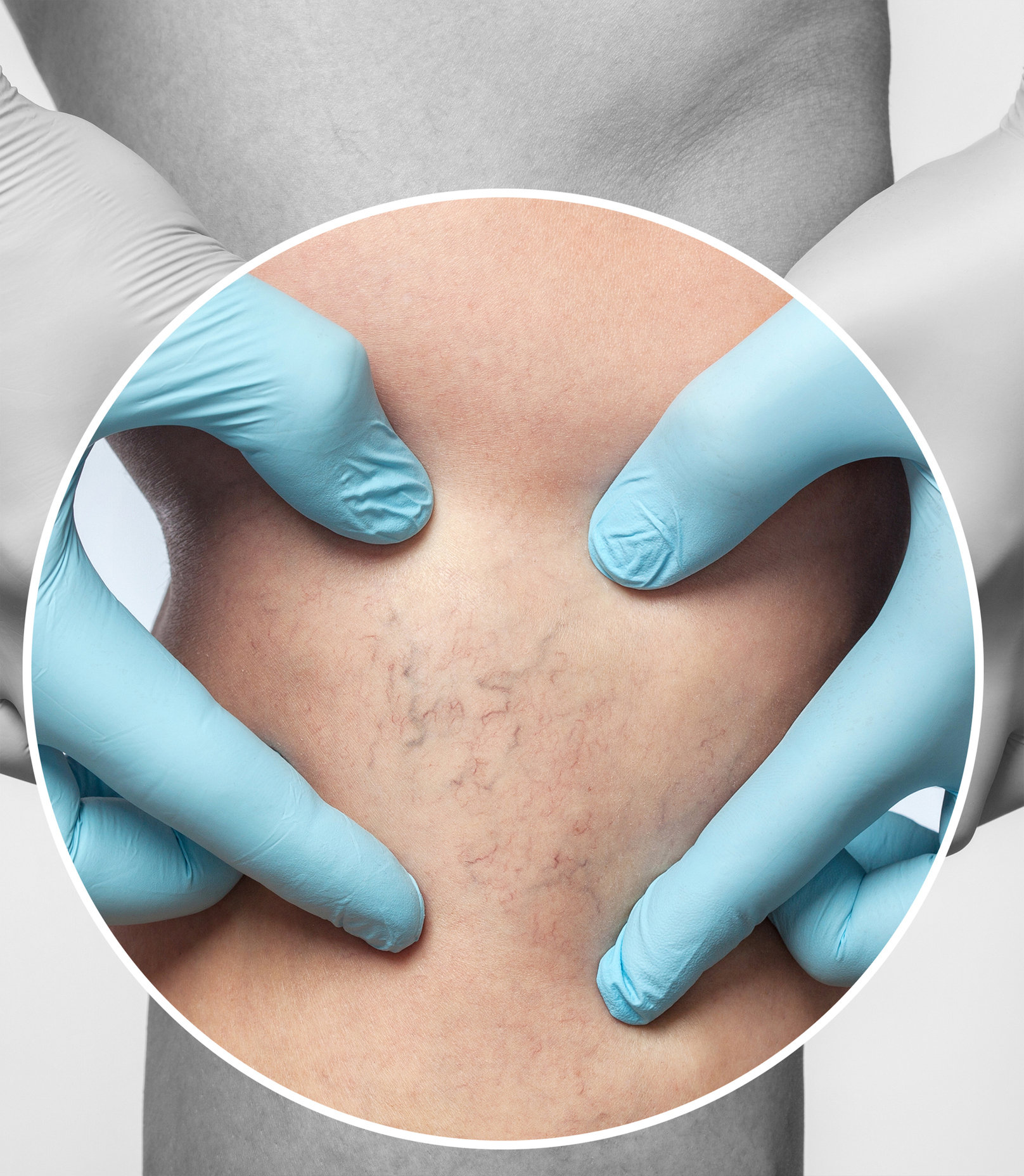 Что такое варикоз? Что вызывает варикоз? Симптомы и лечение